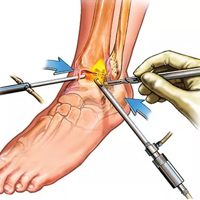 Ankle Surgery