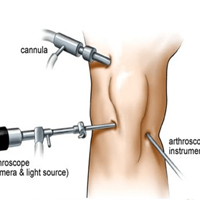 Arthroscopy