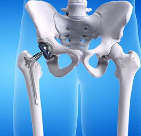 HIP REPLACEMENT