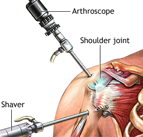 SHOULDER ARTHROSCOPY