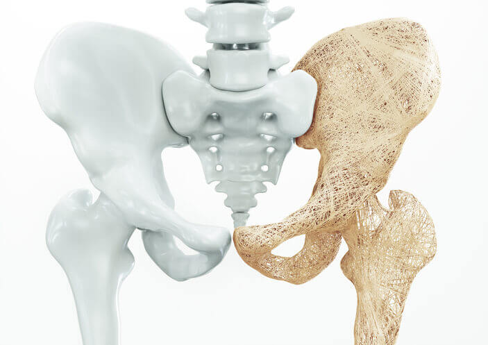 Hip Fractures: Causes, Risk Factors, and Recovery Tips