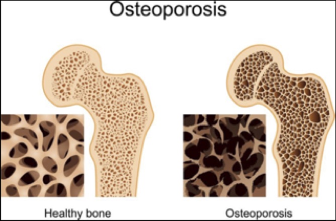 Top 10 Early Signs of Osteoporosis You Should Never Ignore
